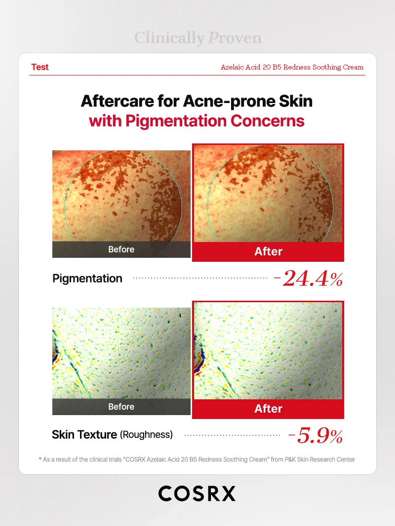 COSRX - Azelaic Acid 20 B5 Redness Soothing Cream (30ml)